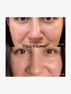 Dr. Lara Devgan Retinol Bakuchiol Serum 5x | MECCA