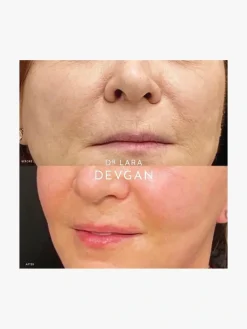Dr. Lara Devgan Retinol Bakuchiol Serum 5x | MECCA